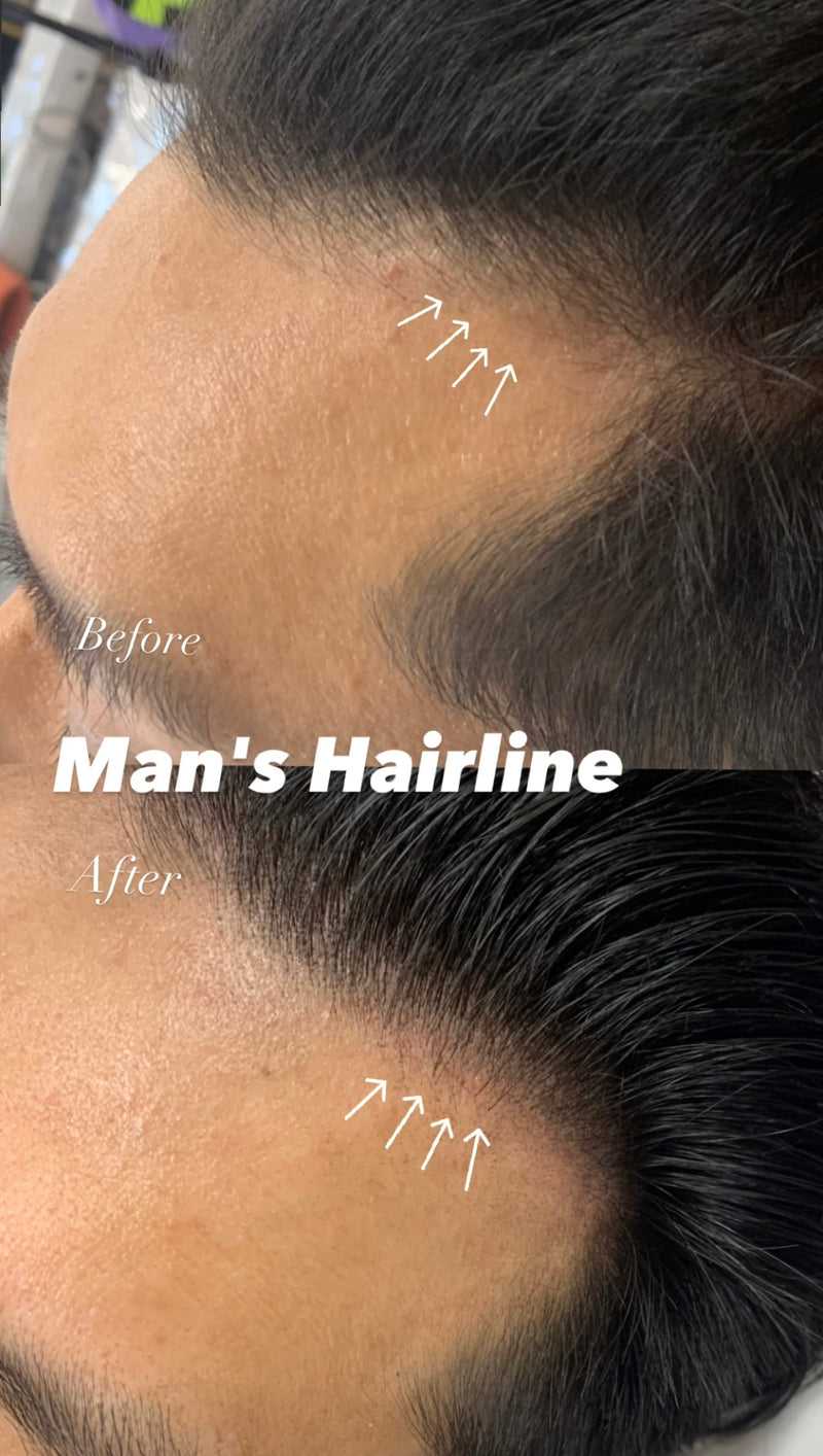 Scalp micropigmentation SMP Los Angeles Koreatown - hair follicle tattoo for hair loss 스캘프 마이크로피그멘테이션 엘에이