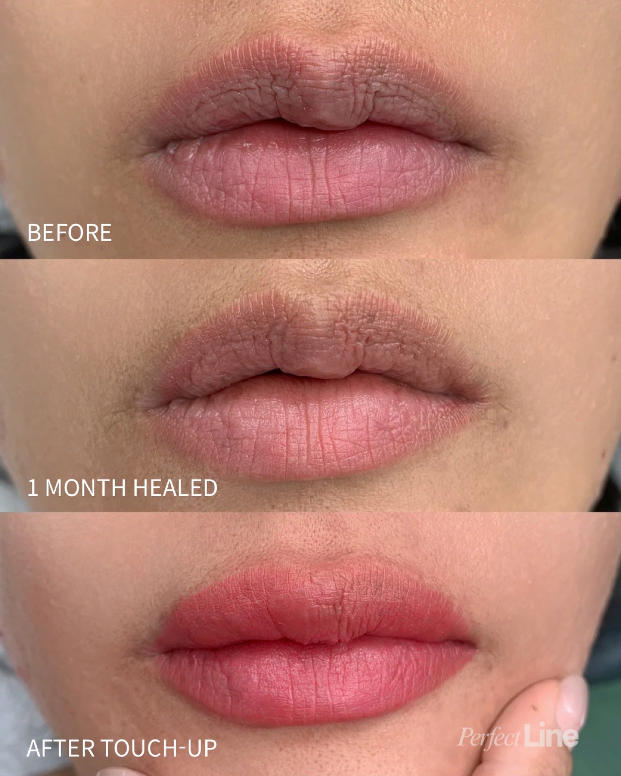 Perfect Line client before lip blush with dark uneven lip tone, one month healed, and after the touch-up showing even soft rose color