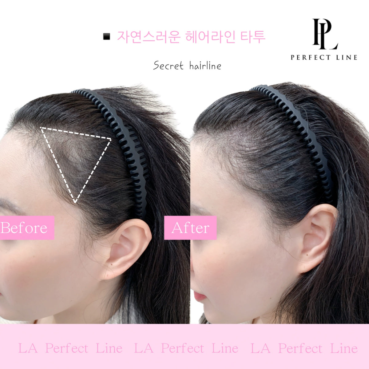 Hairline scalp micropigmentation before and after — Perfect Line Koreatown LA