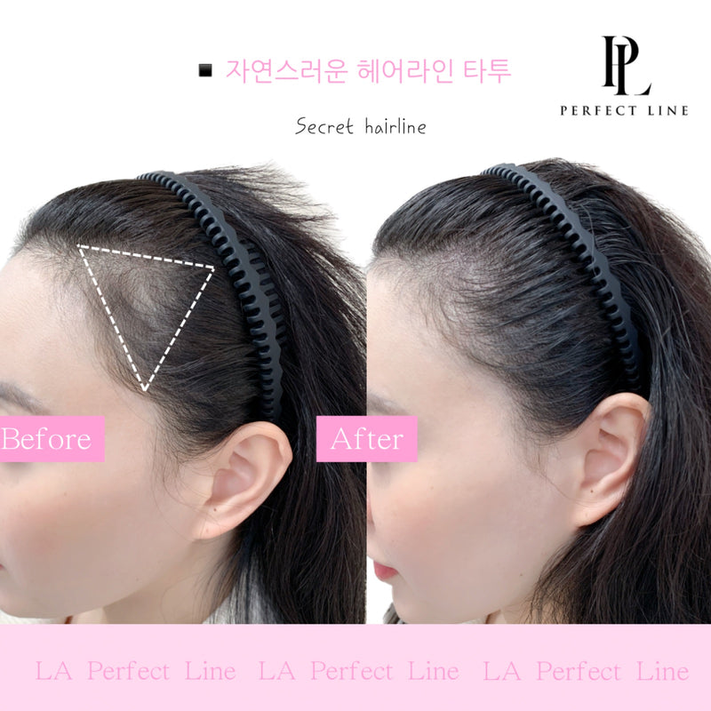 Hairline scalp micropigmentation before and after — Perfect Line Koreatown LA