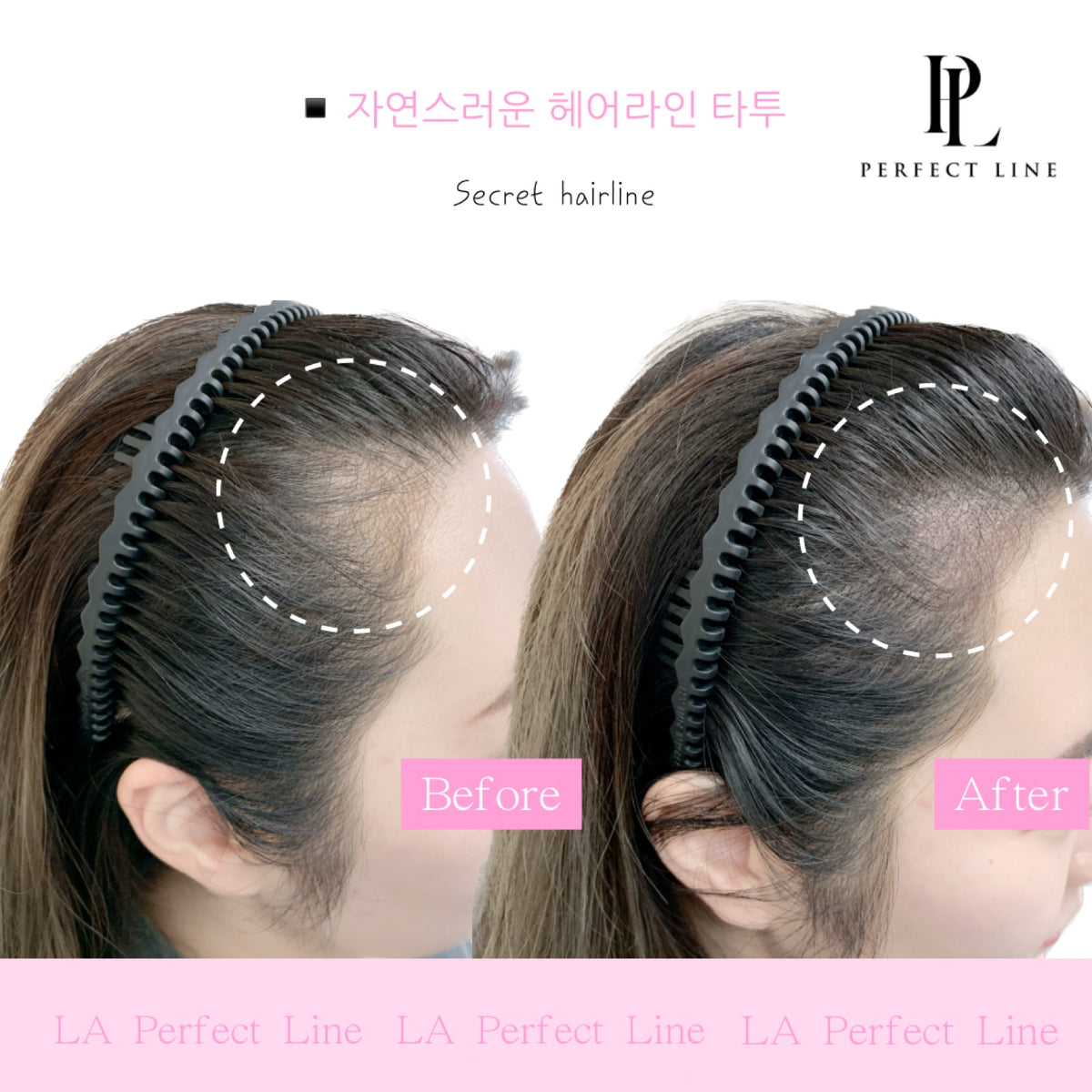 Natural hairline SMP before and after, temple fill — Perfect Line LA
