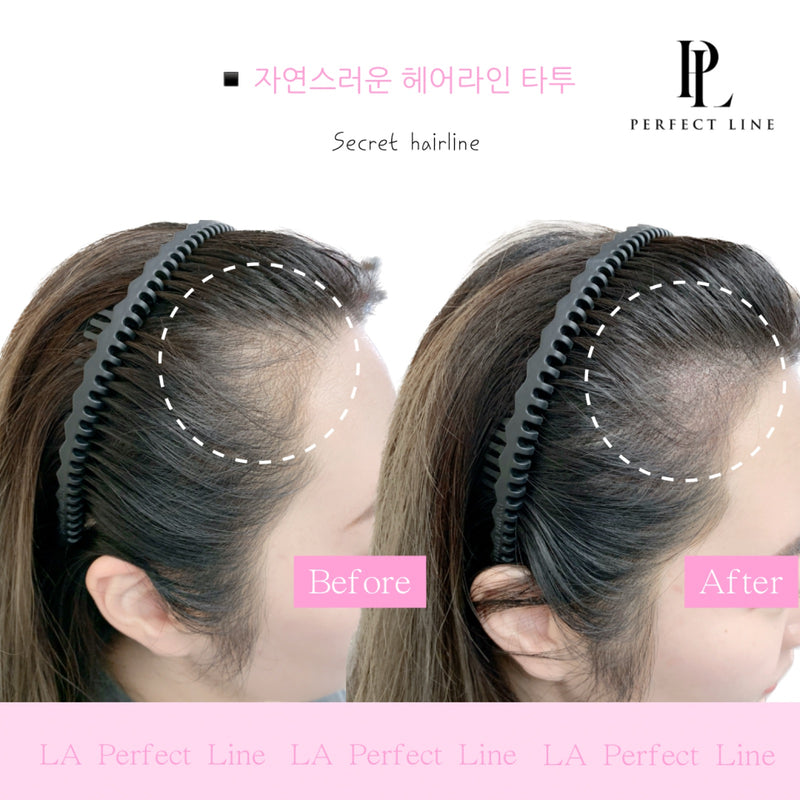 Natural hairline SMP before and after, temple fill — Perfect Line LA