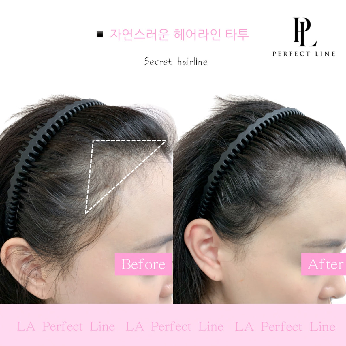 Hairline scalp micropigmentation result — Perfect Line LA
