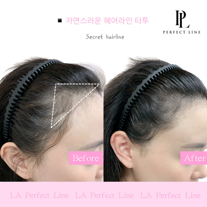Hairline scalp micropigmentation result — Perfect Line LA