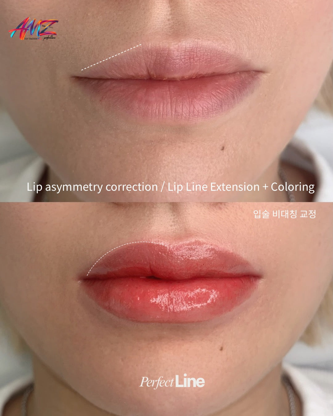 Before and after of a Korean lip blush — lip line extension and color correction